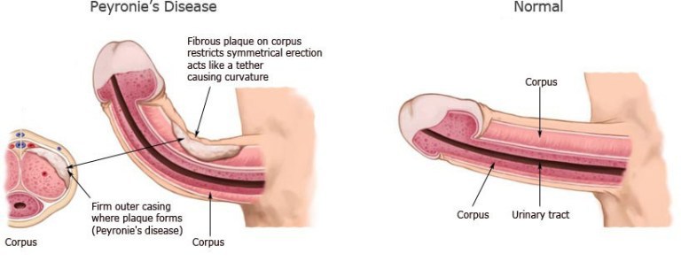 peyronie's disease treatment in London to straighten the shaft